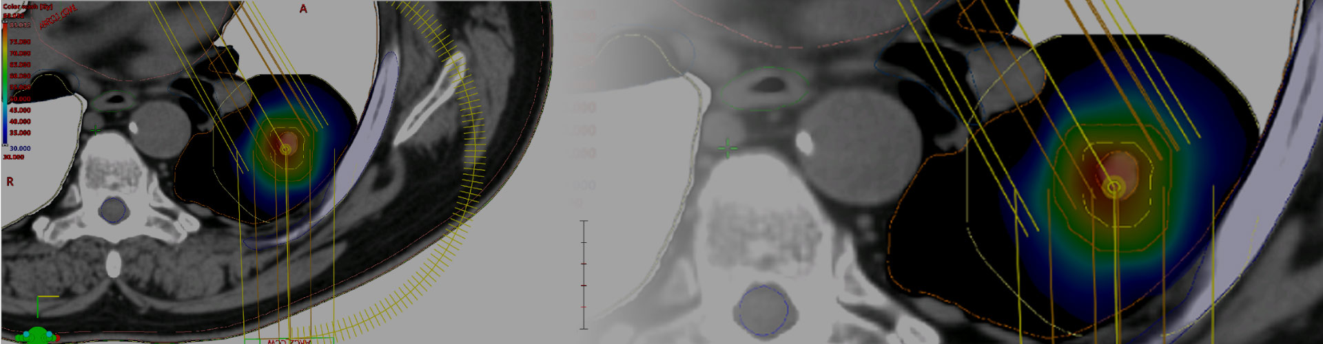 SBRT (Radiochirurgie extracrânienne)